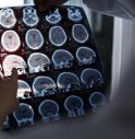 Da test precoci a nuove terapie, corrono studi su Alzheimer.