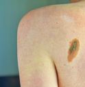 Tumori, +30% diagnosi melanoma in 2024, mai così tanti.