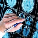 Nuova frontiera anti-Alzheimer: così si combattono le proteine tossiche.