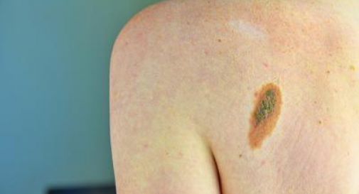 Tumori, +30% diagnosi melanoma in 2024, mai così tanti.